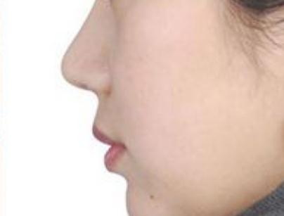 打玻尿酸填充鼻子的危害_大分子玻尿酸填充鼻子会变宽吗
