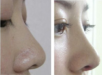 鼻基底凹陷可以填充玻尿酸吗_鼻基底凹陷和法令纹怎样消除
