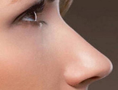 超体隆鼻材料
