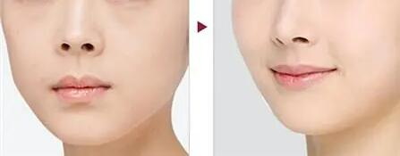 鼻子红怎么治疗和修复