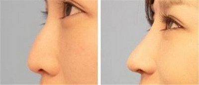 玻尿酸隆鼻几天可以恢复_玻尿酸隆鼻前后照片对比