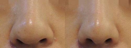 鼻子综合整形恢复_广州鼻子整形手术
