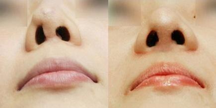 直鼻子和小翘鼻哪个好看_韩式小翘鼻:一场美丽的蜕变