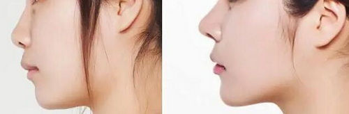 鼻子打完玻尿酸多久可以做假体隆鼻(鼻子打完玻尿酸多久可以做假体隆鼻)
