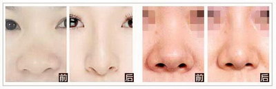 鼻翼外切的疤痕多久才不明显_鼻翼外切增生是什么样子