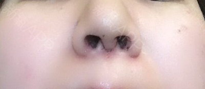 做肋骨鼻子可以保持多久_做完肋骨鼻怎么清理鼻孔