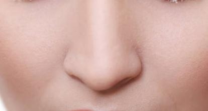 鼻综合后鼻子变成两倍大_鼻综合做完后鼻子山根低