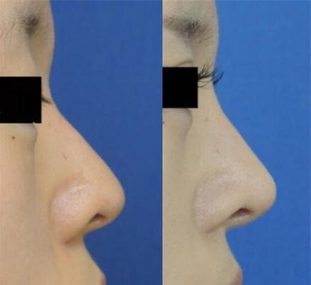 蛋白线隆鼻能维持多久