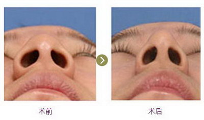 鼻综合术后两个月可以化妆吗_鼻综合三个月后会变得自然吗