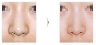 鼻子排异反应怎么处理