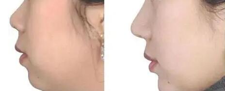 鼻假体取出多久可以重新植入