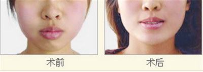 唇腭裂几个月能查出来_唇腭裂术后护理重点