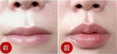 嘴唇可以用什么形容词代替_嘴唇里面拆线后要注意什么
