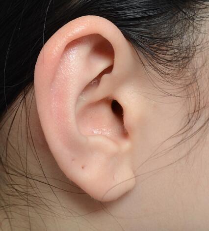副耳怎么形成的_副耳整容术