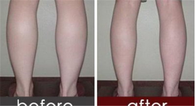 大腿抽脂后什么时候能看到效果_大腿抽脂什么时候开始越来越瘦