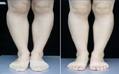 大腿抽脂后多久可以正常下蹲(大腿抽脂后多久可以恢复正常饮食)