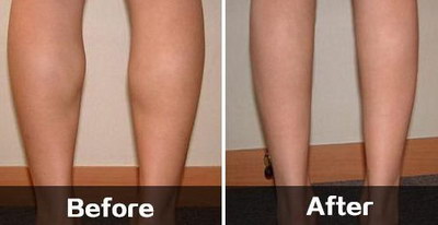 刮痧减大腿的正确方法_减大腿肚子的运动姿势