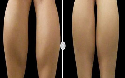 女人大腿内侧抽脂手术
