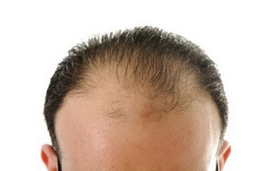 脱发严重植发可靠吗_脱发一年半了还能恢复吗