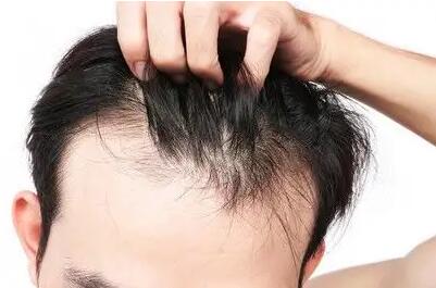 内分泌失调导致的脱发还能长回来吗_脂溢性脱发是什么原因引起的怎么治疗