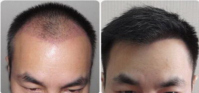 遗传性脱发的症状_植发能治好遗传性脱发吗