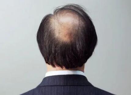 治疗白发脱发的中药配方_怎么治疗脂溢性脱发