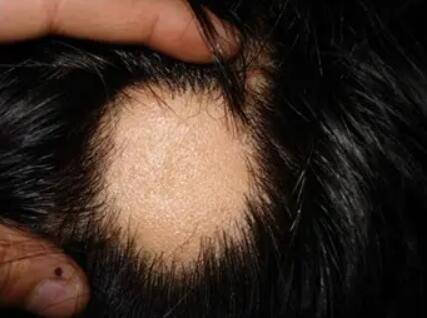 防生密脱发发(预防脱发的重要性)