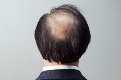 雄性激素过多引起的脱发怎么治疗【雄性激素过多引起脱发怎么治】
