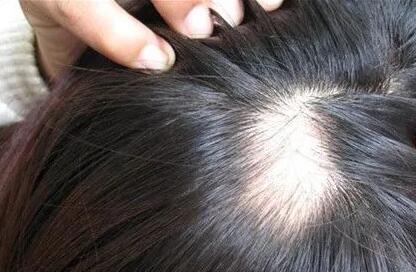 女人产后脱发原因及治疗_女人脱发的主要原因