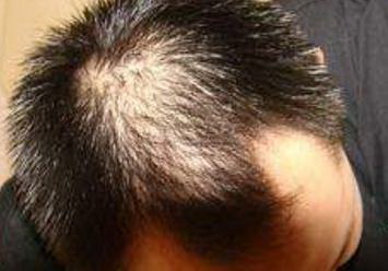 遗传性脱发可以治疗吗(遗传性脱发的特点)