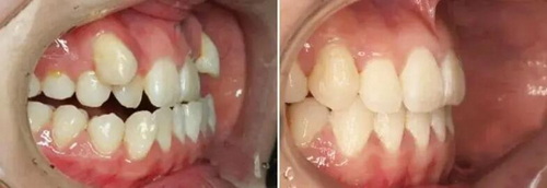 拔牙后第十天牙洞里肉白白的_拔牙的牙洞多久才能随便吃饭