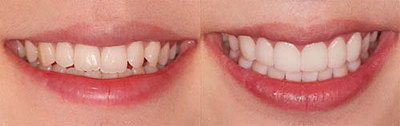 可摘义齿的修复方式_口腔义齿工艺是什么