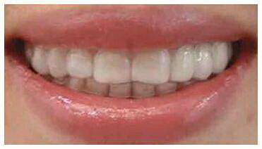 龅牙矫正要多久才能不龅牙了_龅牙矫正要多长时间可以矫正好