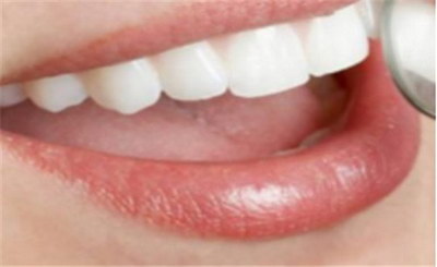 后牙根管治疗但是张口受限_做完根管治疗后牙齿变色吗