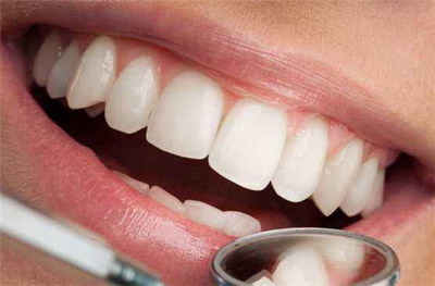 冷光美白牙齿可以维持多久_冷光美白牙齿术后注意事项