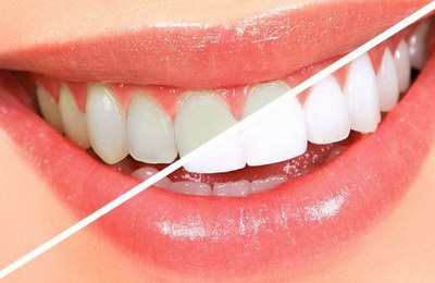 全瓷牙可以做根管治疗吗