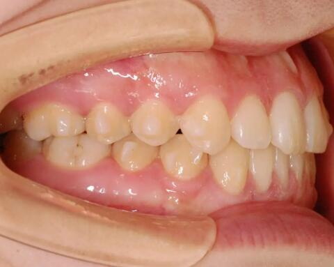 用手抠牙齿和牙龈交界酸痛(手抠牙齿和牙龈交界酸痛是什么原因？)