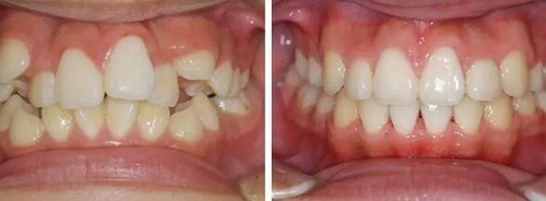 根管治疗把牙齿钻穿了怎么办_做了根管治疗的牙齿热的就疼