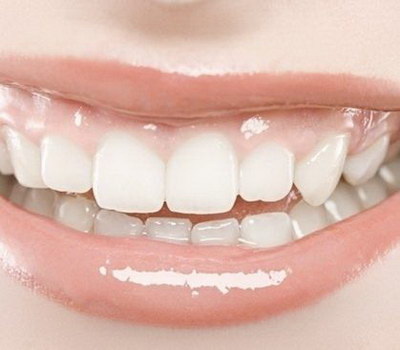 拔牙后牙龈能长一起吗