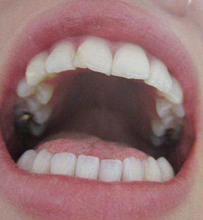 种植牙是什么材质_种植牙是什么样子