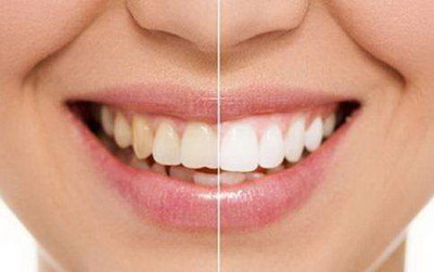 牙齿多大的缺口可以补牙