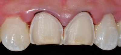 拔牙需要挂口腔科的什么科_拔牙需要恢复多长时间