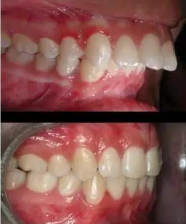 根管治疗嵌体修复和牙冠区别