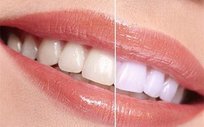 怎么才能使牙齿变成白