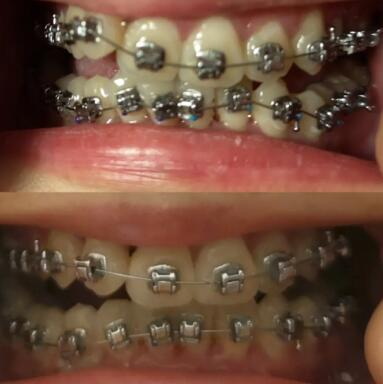 乳牙之后是什么牙齿_乳牙地包天最佳矫正年龄