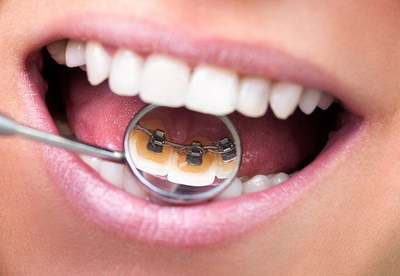 牙齿矫正怎么分骨性还是牙性