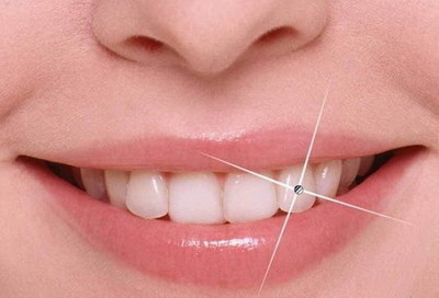 3m纳米树脂补牙和树脂补牙区别_3m纳米树脂补牙寿命