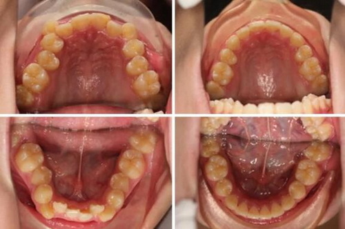 牙齿根管诊疗时间(牙齿根管诊疗过程)