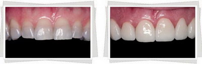 牙齿根管治疗全过程视频_牙齿根管治疗是怎么样的