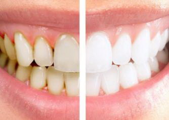 拔牙拆线后注意事项是什么_拔牙第二天凝血有一层白膜